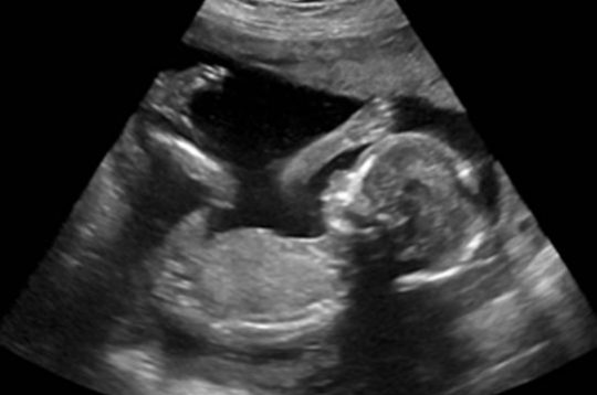 Ultrasound nuchal result translucency Nuchal Translucency