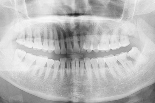 OPG Lateral Cephalometry