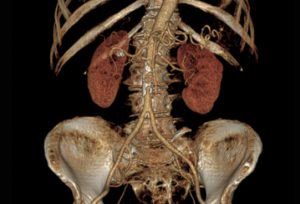 CT Scan