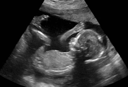 Nuchal Translucency Ultrasound